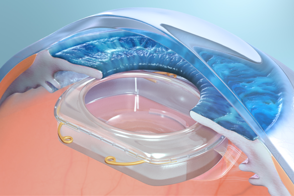 Omega Ophthalmic's "glove" that would allow for multiple capabilities to be on-boarded into the eye.